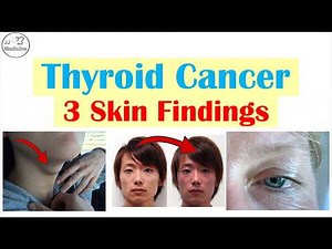 3 Skin Clues That Could Point to Thyroid Cancer