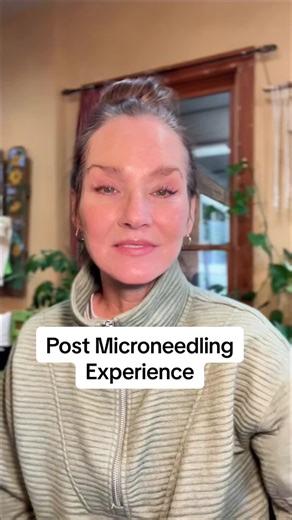 Post Microneedling Experience: What to Expect
