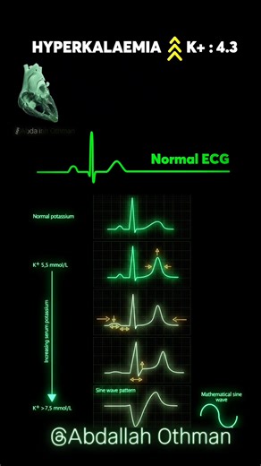🚨 Hyperkalemia : ECG Essentials 🚨 ✔️ HyperK: Peaked T → Sine wave → Cardiac arrest. Watch how increasing potassium levels affect the heart. As K rises, notice these ECG changes: Flattened P Wave: Impaired atrial depolarization. Widened QRS Complex: Delayed ventricular depolarization. These changes can lead to severe arrhythmias and potentially cardiac arrest if not treated promptly. #Hyperkalemia #Cardiology #ECG #MedicalEducation #CardiacArrest #Healthcare👇🏻 Save 📌 | Share 🔗 | Tag a colle