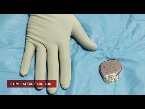 Implantation d'un stimulateur cardiaque