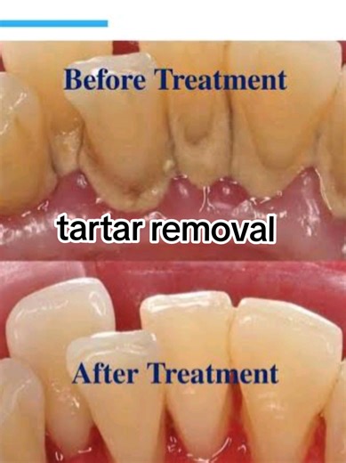 how to remove tartar #teethcare