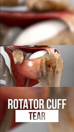 What Are the Most Common Shoulder Injuries in Sports- Shoulder Specialist