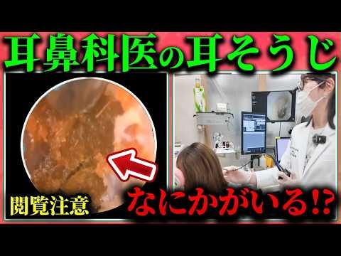 [HUGE EARWAX] Ear cleaning. Featuring some intense cases that block the eardrum [#EarCleaningASMR]