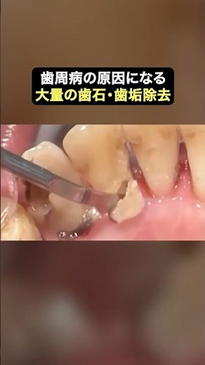 [Dental scaling] Let's eliminate the cause of periodontal disease ✨ #TheWhiteDentalClinic #Dentis...
