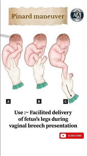 Pinard maneuver..#aiimsaspirant #norcetmcq #nursing #viral #song #obg #procedure #motivation #trend