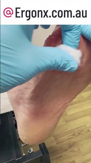 Podiatrist's Easy Callus Removal Tips for Smooth Toes! #FootCare #CallusRemoval