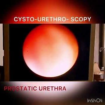 STRICTURE URETHRA - CYSTOSCOPY - URETHROSCOPY
