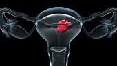 uterus malignant tumor, Female uterus anatomy, Reproductive system,...