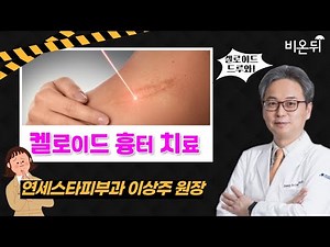 '켈로이드 흉터 치료' (연세스타피부과 이상주 원장)