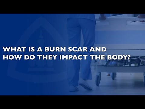 Burn Scar Treatment Q&A