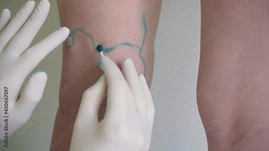 Vein markup. Vascular surgeon is marking veins for varicose surgery