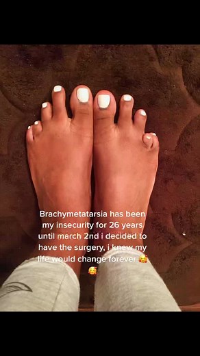Conquering Brachymetatarsia: My Journey to Overcoming Short Toe Problems