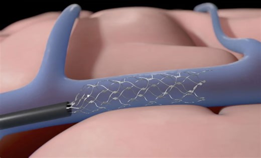 Synchron Unveils World’s First "Thought-Driven Control" of an Apple iPad in New Brain-Computer Interface Milestone