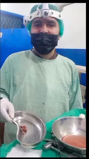 Rhinolith/ Nasal Stones removal under 4mm Zero Degree Nasal Endoscope