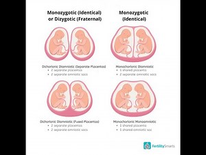 Monochorionic Diamniotic Twins and It's Embryological Basis