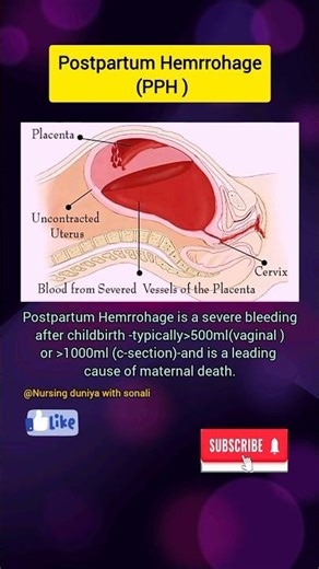 💥pph#obg#obgyn#medical #hospital#health#shorts
