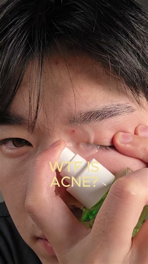 WTF IS ACNE#skincare #skincareroutine #acne #acnetreatment #acnescars #brightskin #kbeauty #skincare
