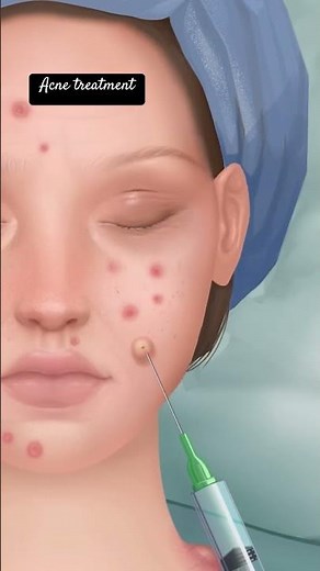 Wow Incroyable/Crazy Sebum extraction #asmr #animation #makeover #makeup