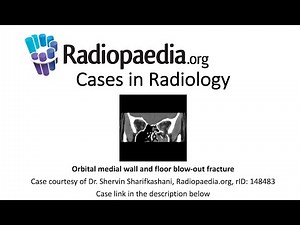 Orbital medial wall and floor blow-out fracture (Radiopaedia.org) Cases in Radiology