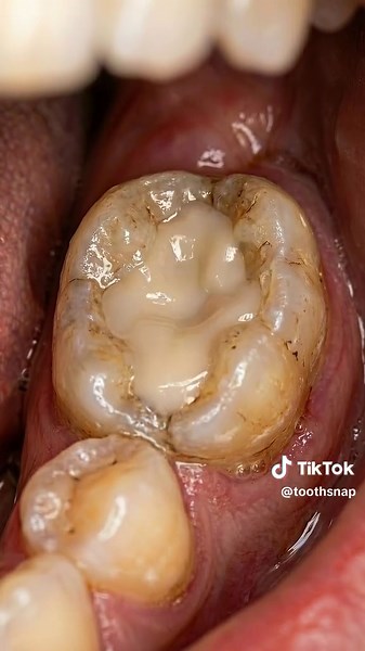 Dentist Cleans a Severely Broken Tooth & Rebuilds It #dentalcleaning #satisfying #toothcleaning #asmr