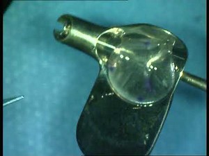 DSAEK Corneal Transplant Using Busin Glide