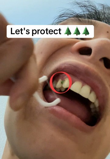 Tonsil stones removal Eat more veggieeeeee #tonsilstones batu amandel dicabut flossing teeth Removing Tooth #Plaque flossing teeth benefits proper flossing of teeth not flossing your teeth flossing teeth plaque #flossing #floss #asmr #asmrsounds #asmrvideo #asmrtiktoks