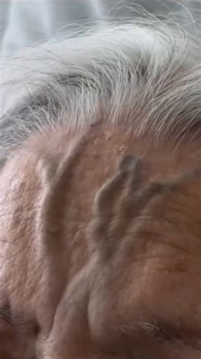 Bio_medicine on Instagram: "An 89-year-old woman with severe tricuspid regurgitation presented with fever and cough after a recent diagnosis of influenza. Prominent forehead venous pulsations were noted on examination. ⁣ ⁣ Read the full case details in the Images in Clinical Medicine article “Forehead Venous Pulsations in Severe Tricuspid Regurgitation,” from @umiamimedicine, at NEJM.org ⁣ #Cardiology #NEJM #influenza #cough #tricuspidregurgitation"