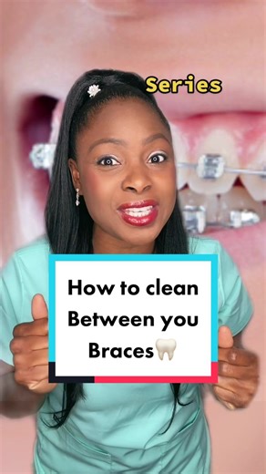 How to Clean Your Braces: Tips for Dental Hygiene at Home