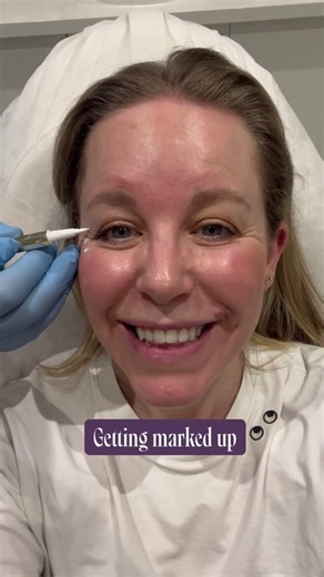 We tried the new toxin injection that works in 36 hours 😮