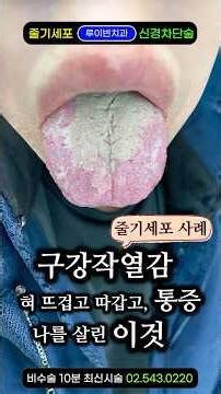 "입안이 활활 타요" 혀·입술·목구멍 따가운 구강작열감 (삼차신경통) 구강건조·쓴맛·혓바닥갈라짐·잇몸, 입천장 이물감·얼얼함...저녁이면 더 아파요