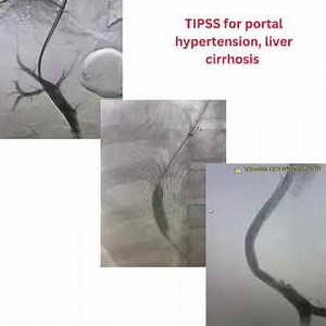 TIPSS Procedure for Liver Cirrhosis by Dr. Suresh Giragani