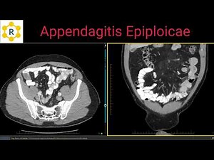 Appendagitis Epiploicae