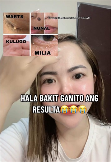 Effective Kasoy Cream for Warts and Milia Removal