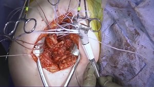 Complex Fracture Tuberosity Management: Live RTSA surgical technique utilizing the press-fit Catalyst Fracture System