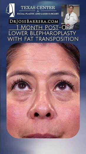 ✨ 1 Month Post-Op Lower Blepharoplasty with Fat Transposition ✨
