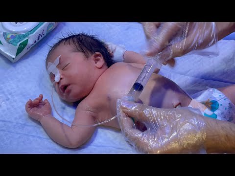 Inserting NG Tube for Baby Feeding | Life-Saving NICU Procedure