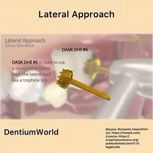 5K views · 192 reactions | Sinus Lift. #Dentistry #LearningTips | Bites & Braces Dental | Facebook