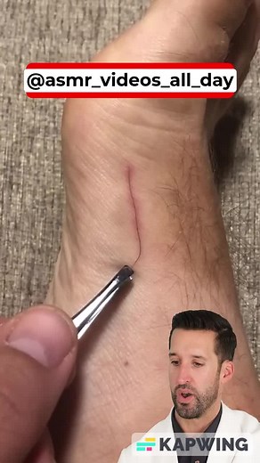 Can we just take a moment to appreciate the oddly satisfying, yet cringe-worthy sensation of watching an ASMR doctor remove hair splinters? 🤯 #ASMR #SplinterRemoval #DoctorReactions