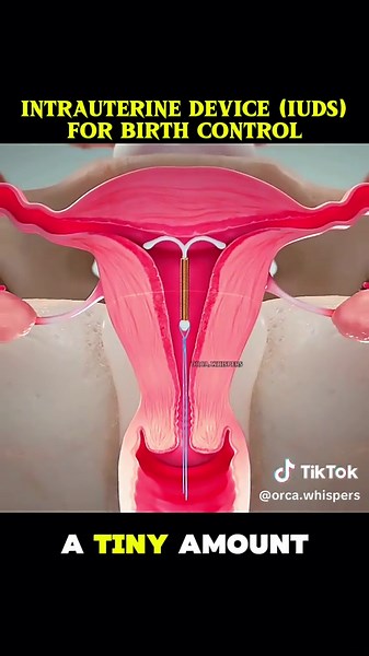 Intrauterine Device (IUD) Birth Control Explained with Clear, Safe, and Precise Medical Detail. #iud #intrauterinedevice #birthcontrol #iudinsertion #medicalfacts