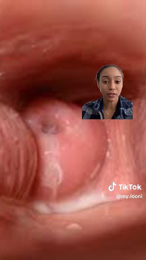 *Changes in cervical position*⁠ ⁠ Did you know that tracking your cervical position can give you insights into your fertility? During ovulation, the cervix moves up high and becomes soft, wet, and open (SHOW). After ovulation, it becomes lower, firmer, and drier. During menstruation, it’s low and hard but slightly open. Have you tried tracking your cervical position as part of your cycle tracking? Let us know in the comments! 🌸 ⁠ ⁠ #cervixchecking #cycletracking #fertilityawareness #menstrualhe