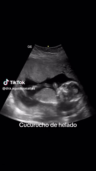 ✨ 18 semanas de embarazo Tu bebé ya mide alrededor de 14–15 cm y pesa cerca de 200 gramos. Empieza a moverse con más fuerza y podés sentir los primeros “golpecitos” si todavía no aparecieron. Su sistema nervioso se sigue desarrollando, los oídos maduran y ya escucha sonidos del exterior, incluyendo tu voz y los latidos de tu corazón. El cuerpo crece más proporcionado, y sus huellitas digitales comienzan a definirse 🖐️ #medicina #embarazo #ultrasonido #embarazofeliz #obstetricia