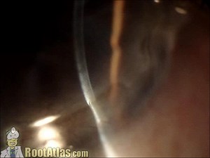 Terrien's Marginal Degeneration (Video) - TimRoot.com