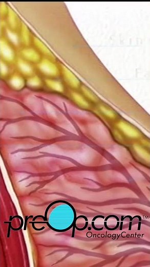 🔍 PreOp® Needle Biopsy Breast 💡 Insight That Empowers Care ✨ #shorts