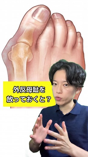 外反母趾と足の健康に関するカイロプラクティック治療方法