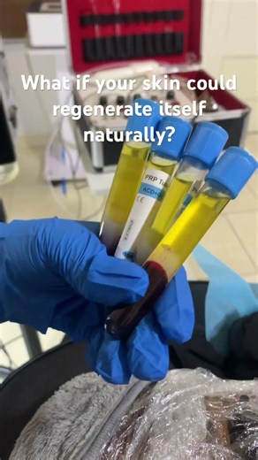 PRP: Unlocking Your Skin’s Natural Healing Power.