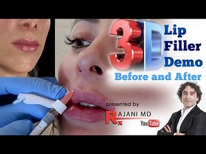 Watch 3D LIP FILLER INJECTIONS// Lip Filler Before and After