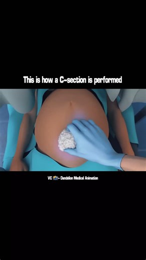 medical_animation on Instagram: "The process of C-section explained . . Amazing Animation by - @dmanimation (Thank you ❤️) . . Link to original video on Youtube channel 👇 https://youtu.be/pSJcxYg1QQ4?si=VugxpkIiHBNHLkYJ"
