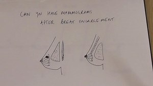Can You Still Get a Mammogram After a Breast Enlargement Procedure?