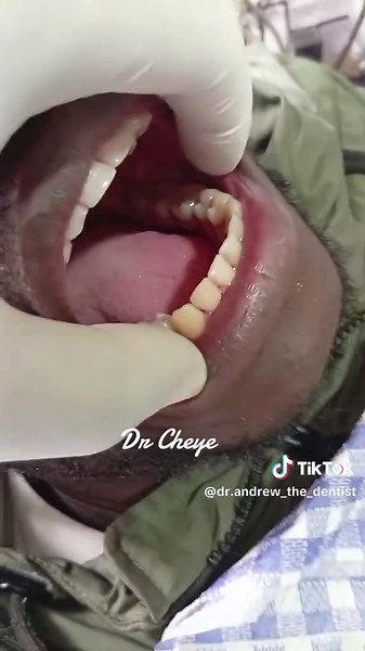 successful MMF💯❤️ we fix fractured jaws.patient full recovered,now we removed the arch bar and splint wire. #WaysideMedicalClinicMbale #MMF #vihigacounty #dentalservices #fyppppppppppppppppppppppp