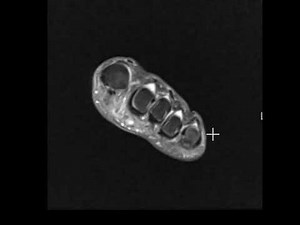 Epidermal inclusion cyst or adventitial bursitis